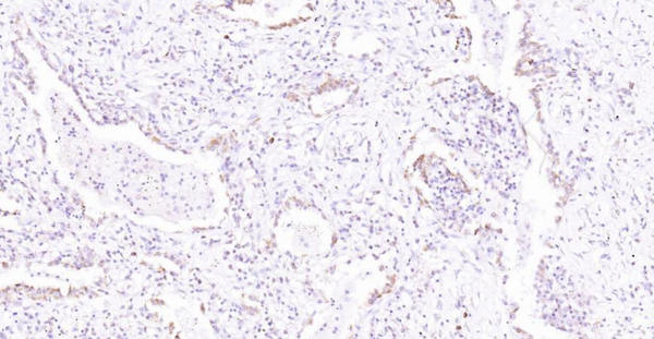 Immunohistochemical analysis of paraffin embedded human lung cancer tissue slide using IHC0131H (Human SLC44A1 IHC Kit).