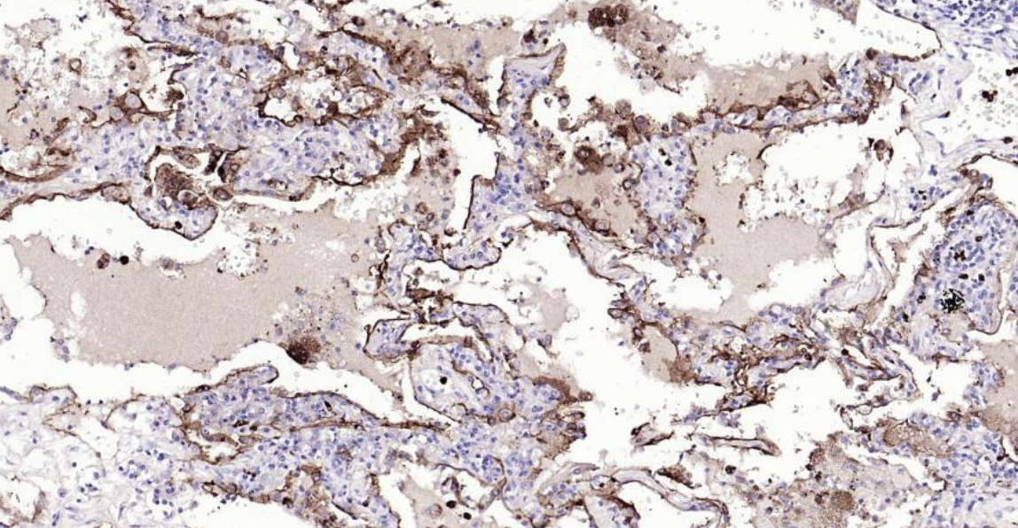Immunohistochemical analysis of paraffin embedded human lung cancer tissue slide using IHC0132H (Human CEACAM5 IHC Kit).