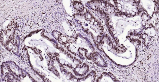 Immunohistochemical analysis of paraffin embedded
human colon carcinoma tissue slide using IHC0180H
(Human BRD7 IHC Kit).