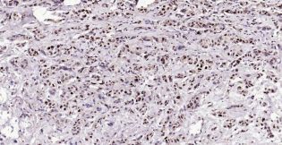 Immunohistochemical analysis of paraffin embedded
human breast carcinoma tissue slide using
IHC0180H (Human BRD7 IHC Kit).
