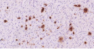 Immunohistochemical analysis of paraffin embedded
human brain with Alzheimer's disease tissue slide
using IHC0186H (Human beta-Amyloid (1-42) IHC Kit).