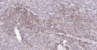 Immunohistochemical analysis of paraffin embedded
human liver carcinoma tissue slide using IHC0189H
(Human COX4I1 (Mitochondrial Loading Control) IHC
Kit).