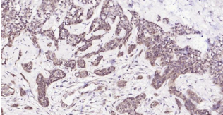 Immunohistochemical analysis of paraffin embedded
human breast cancer tissue slide using IHC0200H
(Human HSC70 IHC Kit).