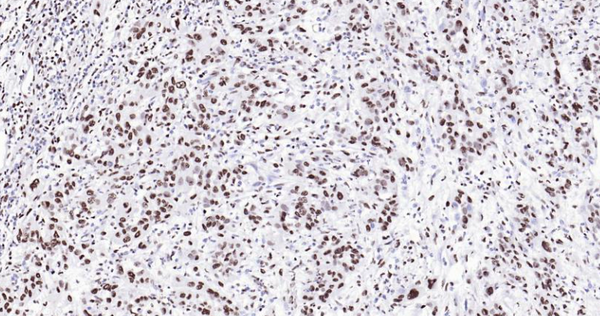 Immunohistochemical analysis of paraffin embedded human gastric carcinoma tissue slide using IHC0105H (Human MYBL2 IHC Kit).