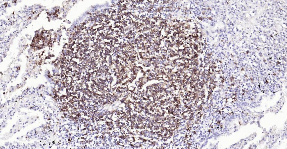 Immunohistochemical analysis of paraffin embedded human lung cancer tissue slide using IHC0125H (Human CD20 IHC Kit).