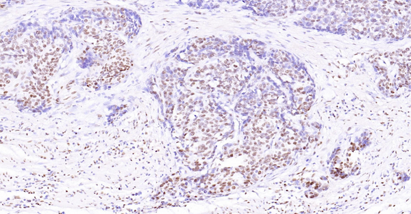 Immunohistochemical analysis of paraffin embedded Human breast cancer tissue slide using IHC0128H (Human ATF4 IHC Kit).