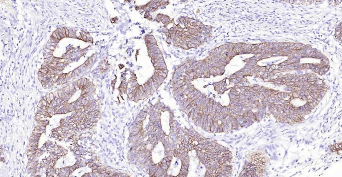 Immunohistochemical analysis of paraffin embedded human colon cancer tissue slide using IHC0130H (Human Cytokeratin 8 IHC Kit).
