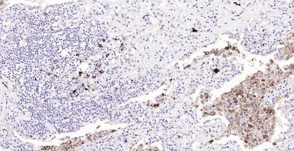 Immunohistochemical analysis of paraffin embedded human lung cancer tissue slide using IHC0133H (Human CD68 IHC Kit).