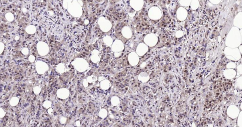 Immunohistochemical analysis of paraffin embedded human breast carcinoma tissue slide using IHC0134H (Human LKB1 IHC Kit).