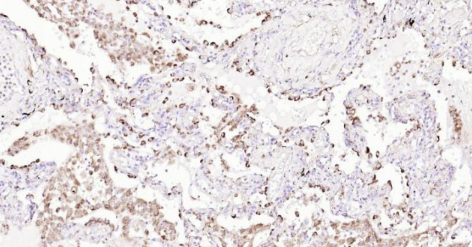 Immunohistochemical analysis of paraffin embedded human lung carcinoma tissue slide using IHC0137H (Human LAMP1 IHC Kit).