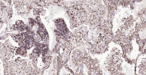 Immunohistochemical analysis of paraffin embedded human lung carcinoma tissue slide using IHC0140H (Human HLA-C IHC Kit).