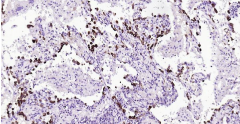 Immunohistochemical analysis of paraffin embedded human lung carcinoma tissue slide using IHC0142H (Human FASN IHC Kit).