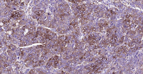Immunohistochemical analysis of paraffin embedded human liver carcinoma tissue slide using IHC0142H (Human FASN IHC Kit).