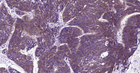 Immunohistochemical analysis of paraffin embedded human breast carcinoma tissue slide using IHC0142H (Human FASN IHC Kit).