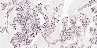 Immunohistochemical analysis of paraffin embedded
human lung carcinoma tissue slide using IHC0180H
(Human BRD7 IHC Kit).