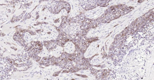 Immunohistochemical analysis of paraffin embedded
human breast carcinoma tissue slide using
IHC0188H (Human STMN1 IHC Kit).