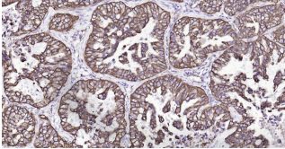 Immunohistochemical analysis of paraffin embedded
human lung cancer tissue slide using IHC0192H
(Human Cytokeratin 19 IHC Kit).