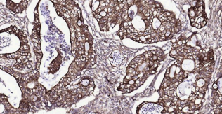 Immunohistochemical analysis of paraffin embedded
human colon cancer tissue slide using IHC0192H
(Human Cytokeratin 19 IHC Kit).