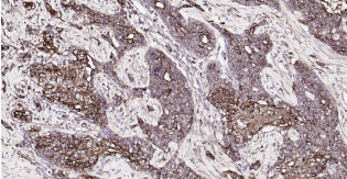 Immunohistochemical analysis of paraffin embedded
human breast cancer tissue slide using IHC0192H
(Human Cytokeratin 19 IHC Kit).