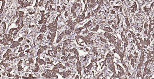 Immunohistochemical analysis of paraffin embedded
human gastric cancer tissue slide using IHC0192H
(Human Cytokeratin 19 IHC Kit).