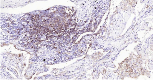 Immunohistochemical analysis of paraffin embedded
human lung cancer tissue slide using IHC0193H
(Human HLA-DR IHC Kit).