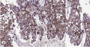 Immunohistochemical analysis of paraffin embedded
human hepatocellular carcinoma tissue slide using
IHC0197H (Human ALDH1A1 IHC Kit).