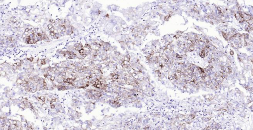 Immunohistochemical analysis of paraffin embe-dded human endometrial carcinoma tissue slide using IHC0112H (Human Cytokeratin 7 IHC Kit). 