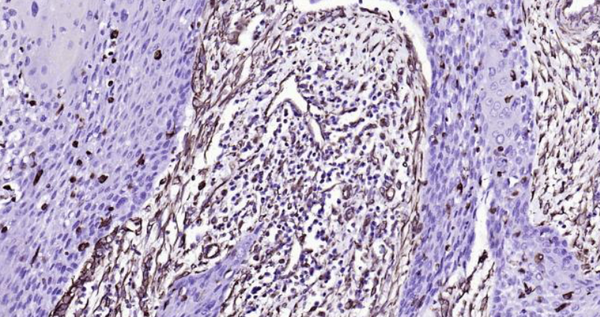 Immunohistochemical analysis of paraffin embedded human cervical carcinoma tissue slide using IHC0113H (Human Vimentin IHC Kit). 
