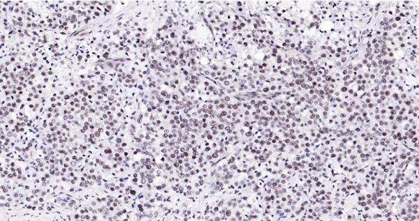 Immunohistochemical analysis of paraffin embedded human prostate tumor tissue slide using IHC0116H (Human HP1 alpha IHC Kit).