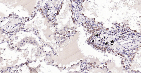 Immunohistochemical analysis of paraffin embedded human lung carcinoma tissue slide using IHC0117H (Human Cytochrome C IHC Kit).
