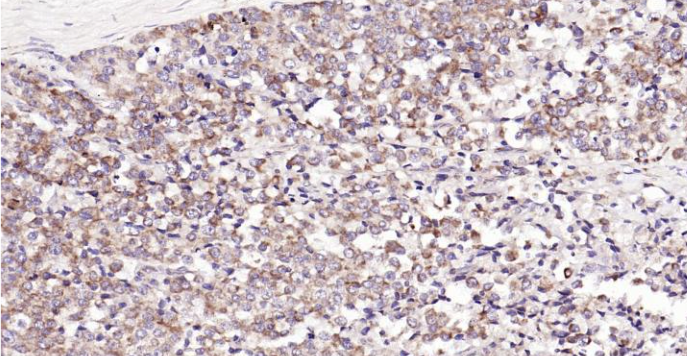 Immunohistochemical analysis of paraffin embedded human prostate tumor tissue slide using IHC0119H (Human CDKN3 IHC Kit).